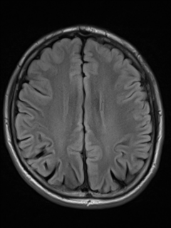 File:Cerebral venous thrombosis (Radiopaedia 38392-40469 Axial FLAIR 16).png