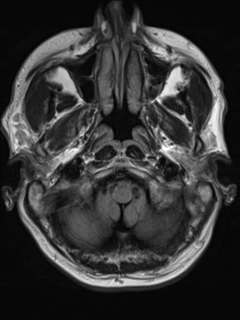 File:Cerebral venous thrombosis (Radiopaedia 38392-40469 Axial FLAIR 3).png