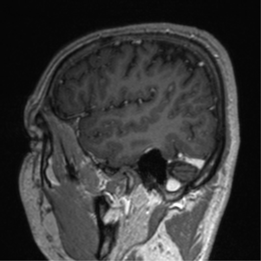 Cerebral venous thrombosis (Radiopaedia 38392-40469 Sagittal T1 C+ 70).png