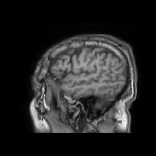 File:Cerebral venous thrombosis with secondary intracranial hypertension (Radiopaedia 89842-106957 Sagittal T1 6).jpg