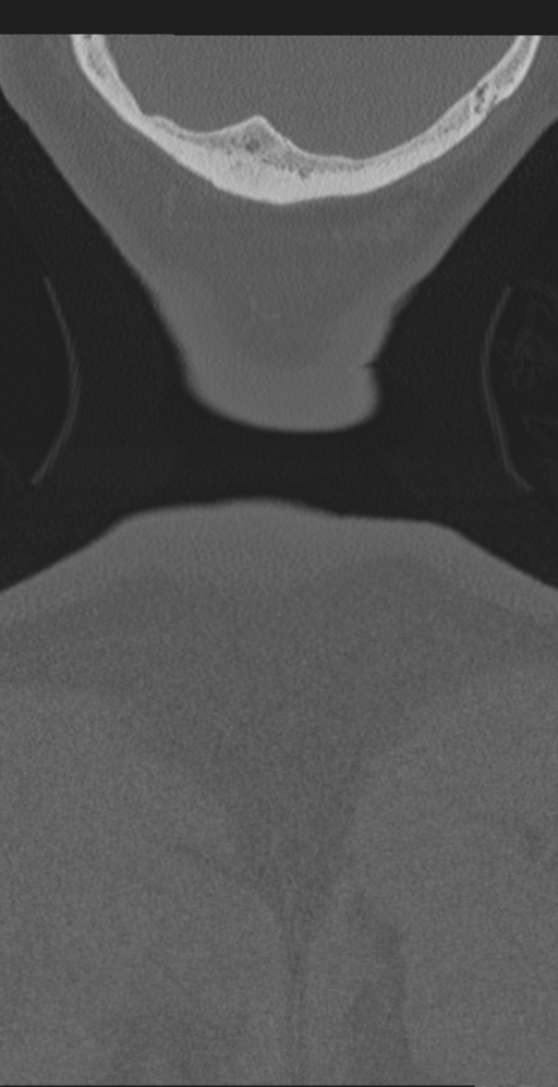 Cervical canal stenosis due to ossification of the posterior longitudinal ligament (Radiopaedia 47260-51823 Coronal bone window 81).png