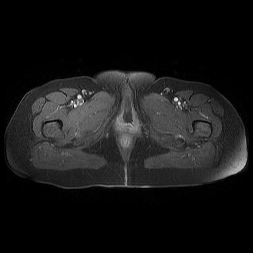 File:Cervical carcinoma (Radiopaedia 67644-77047 Axial T1 C+ fat sat 21).jpg