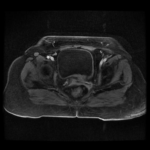 Cervical carcinoma (Radiopaedia 70924-81132 Axial T1 C+ fat sat 46).jpg