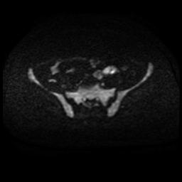 Cervical carcinoma (Radiopaedia 88010-104555 Axial DWI 60).jpg