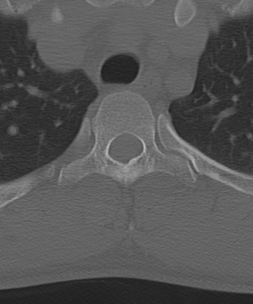 Cervical intercalary bone (Radiopaedia 35211-36748 Axial bone window 72).png