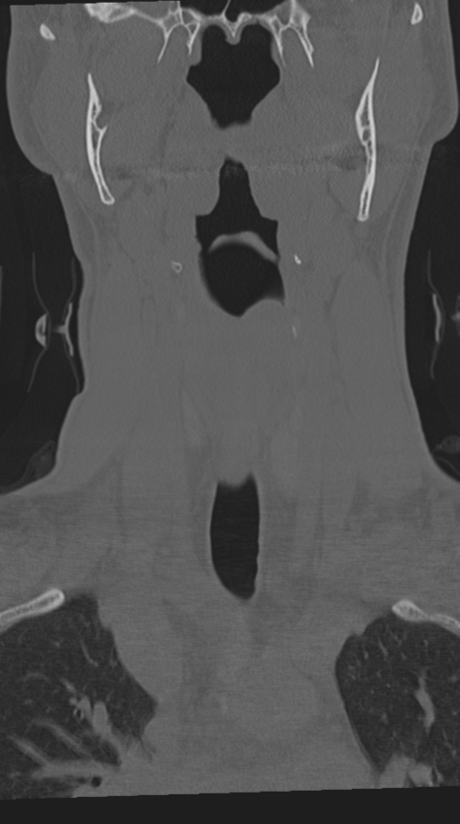 Cervical intercalary bone (Radiopaedia 35211-36748 Coronal bone window 19).png