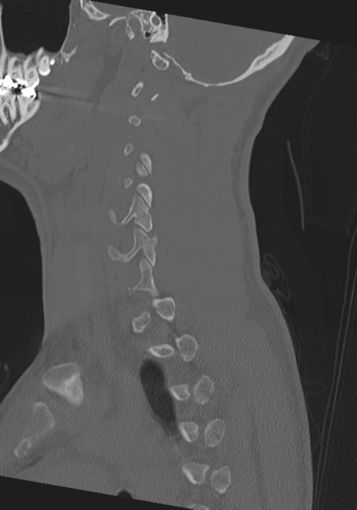 Cervical intercalary bone (Radiopaedia 35211-36748 Sagittal bone window 23).png