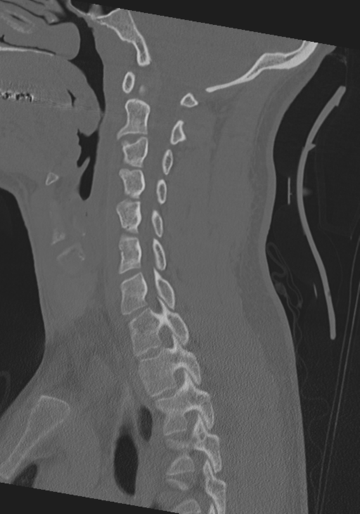 Cervical intercalary bone (Radiopaedia 35211-36748 Sagittal bone window 47).png