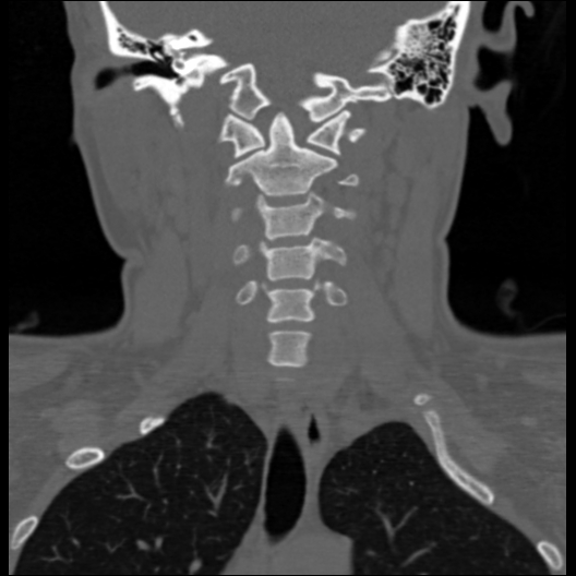 File:Cervical rib (Radiopaedia 71110-81363 Coronal non-contrast 28).jpg