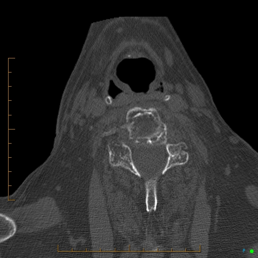 Cervical spine fracture - ankylosing spondylitis (Radiopaedia 76835-88706 Axial bone window 141).jpg