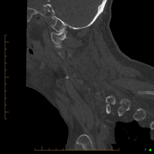 Cervical spine fracture - ankylosing spondylitis (Radiopaedia 76835-88706 Sagittal bone window 86).jpg