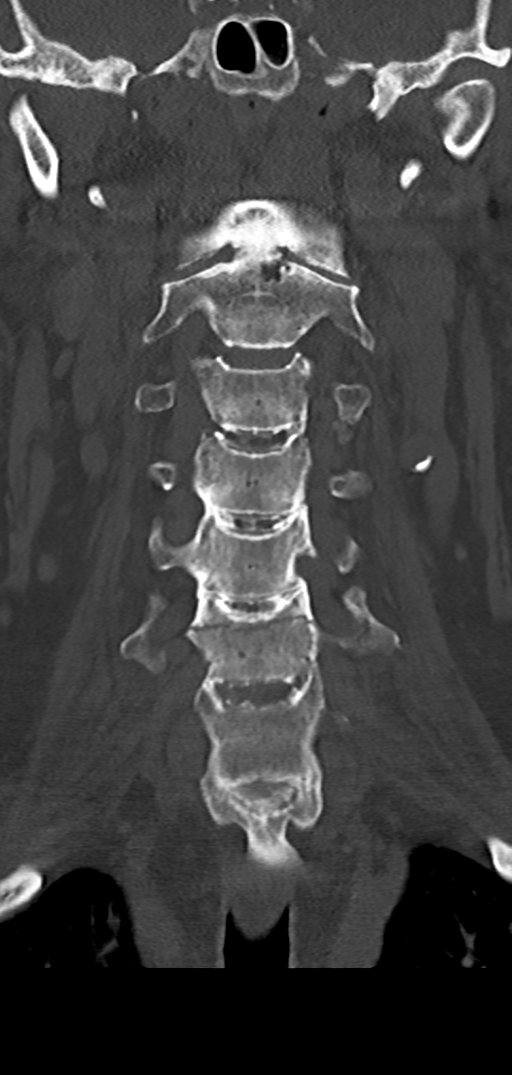 Cervical spine fracture - chalk stick (Radiopaedia 39116-41323 Coronal bone window 19).png