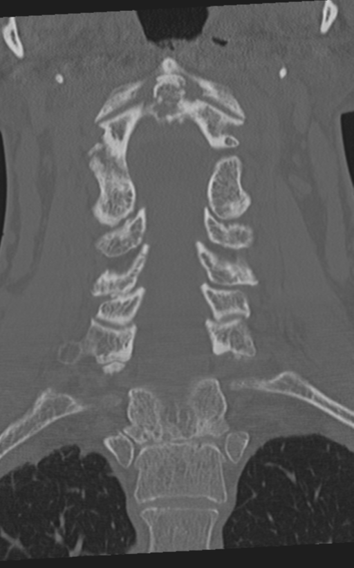 Cervical spine fractures with vertebral artery dissection (Radiopaedia 53296-59268 Coronal bone window 34).png