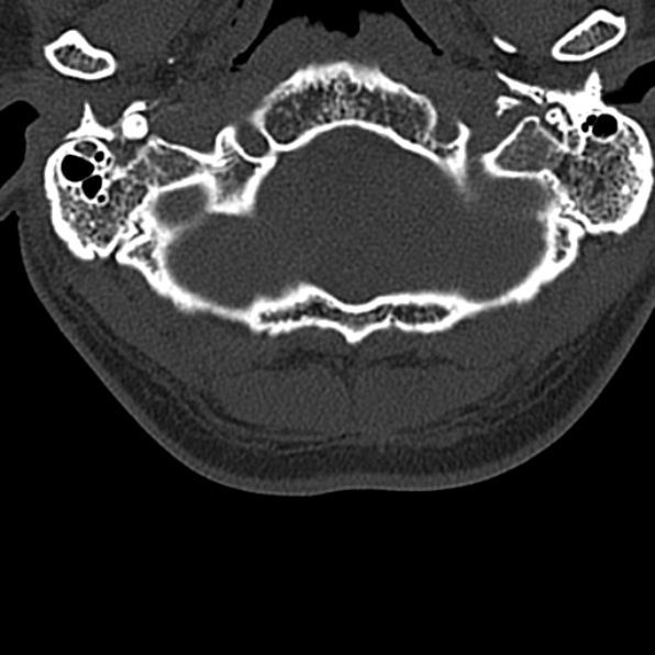 Cervical spondylodiscitis (Radiopaedia 28057-29489 Axial bone window 10).jpg