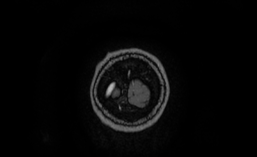 Cervical spondylodiscitis and calvarial hemangioma (Radiopaedia 64317-73103 Coronal T1 C+ 76).jpg