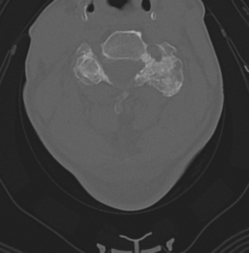 File:Cervical spondylolysis (Radiopaedia 49616-54811 Axial bone window 29).png