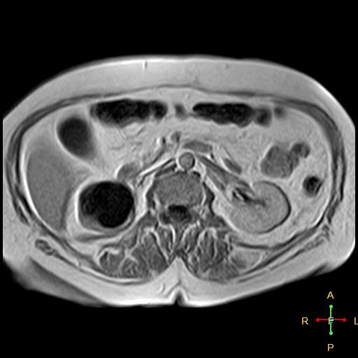 File:Cervical stump squamous cell carcinoma (Radiopaedia 48049-52858 H 2).jpg