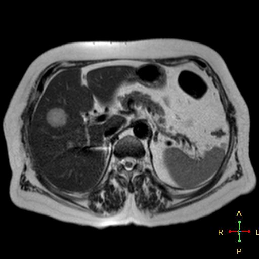 File:Cervical stump squamous cell carcinoma (Radiopaedia 48049-52858 I 9).jpg