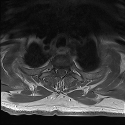 File:Cervical tumor-like myelopathy due to Type V dAVF (Radiopaedia 82461-96604 Axial T1 C+ fat sat 36).jpg