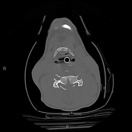 File:Cervical vertebral burst fracture (Radiopaedia 37420-39258 Axial bone window 31).jpg