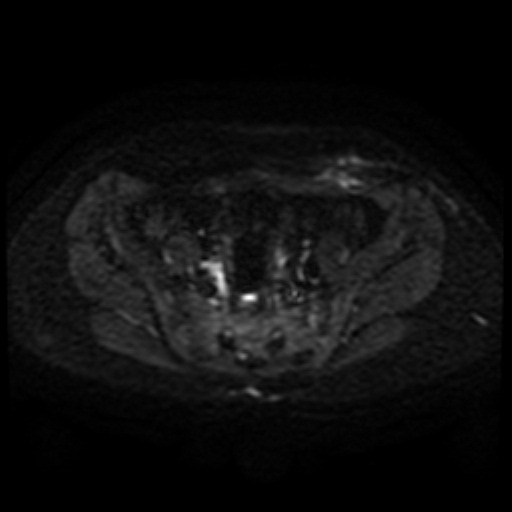 File:Cesarian section scar endometriosis (Radiopaedia 66520-75799 Axial DWI 31).jpg