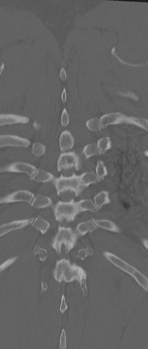 Chance fracture (Radiopaedia 33854-35020 Coronal bone window 72).png