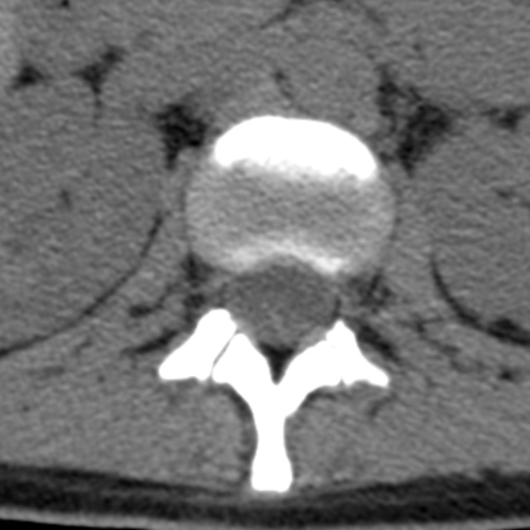 File:Chance fracture (Radiopaedia 36521-38081 Axial non-contrast 75).jpg