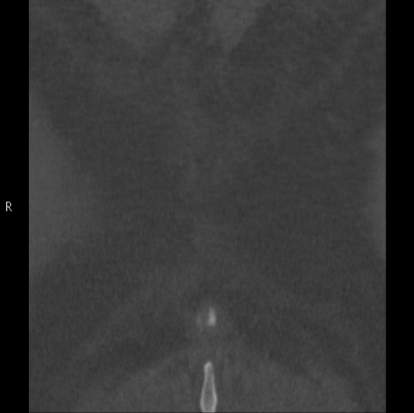Chance fracture (Radiopaedia 36521-38081 Coronal bone window 72).jpg