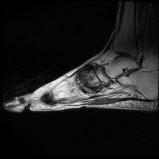 File:Charcot arthropathy (Radiopaedia 55056-61422 Sagittal T2 8).jpg