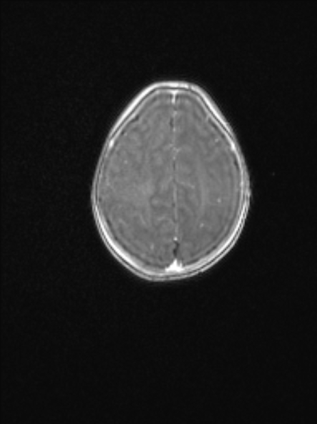 Chiari III malformation with occipital encephalocele (Radiopaedia 79446-92559 Axial T1 C+ mpr 68).jpg