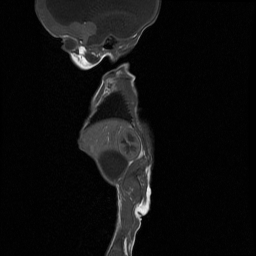 File:Chiari II malformation with spinal meningomyelocele (Radiopaedia 23550-23652 Sagittal T1 11).jpg