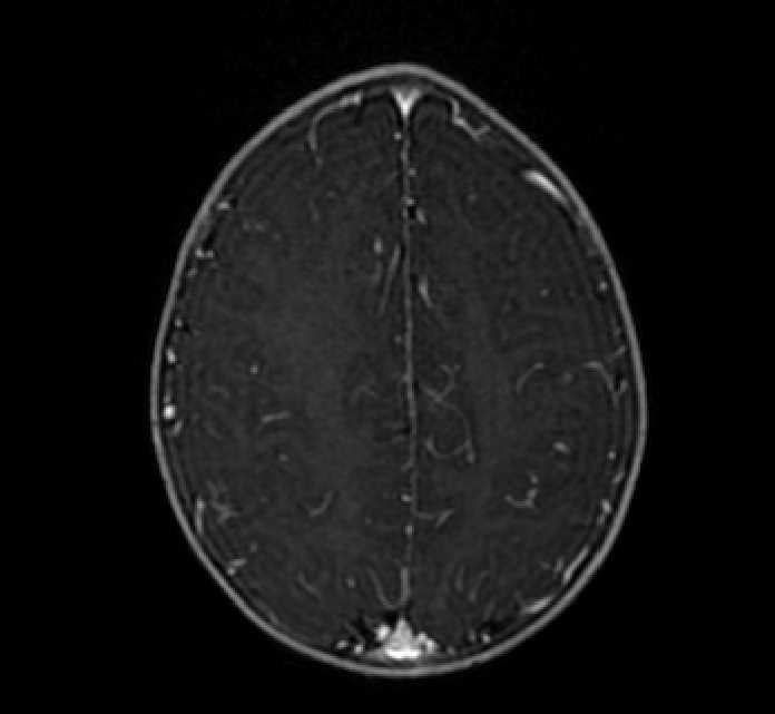 Chiasmatic-hypothalamic glioma (Radiopaedia 90079-107252 Axial T1 C+ 69).jpg