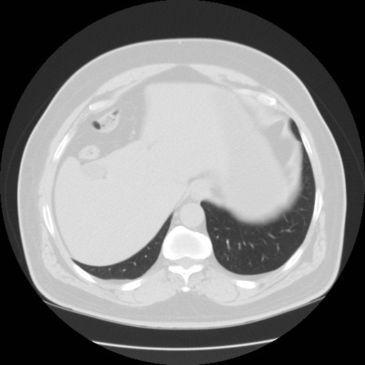 File:Chilaiditi’s syndrome (Radiopaedia 27550-27756 Axial lung window 20).jpg