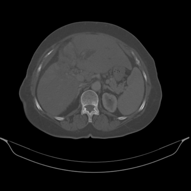 Cholangiocarcinoma (Radiopaedia 50592-56025 Axial bone window 24).jpg