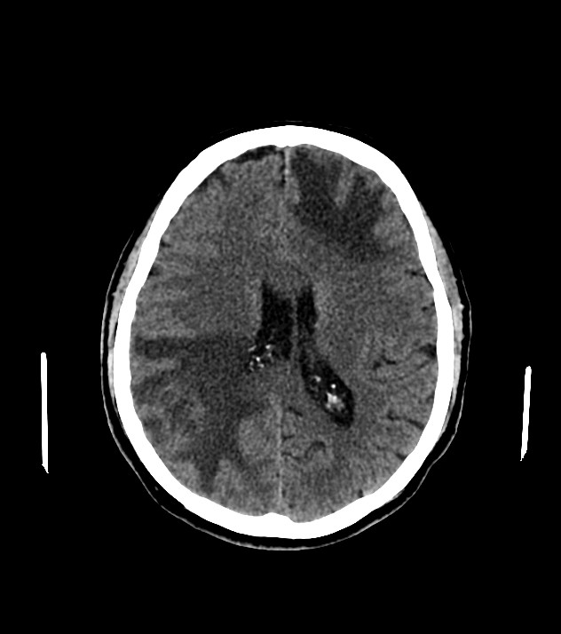 Cholangiocarcinoma with cerebral metastases (Radiopaedia 83519-98628 Axial non-contrast 41).jpg