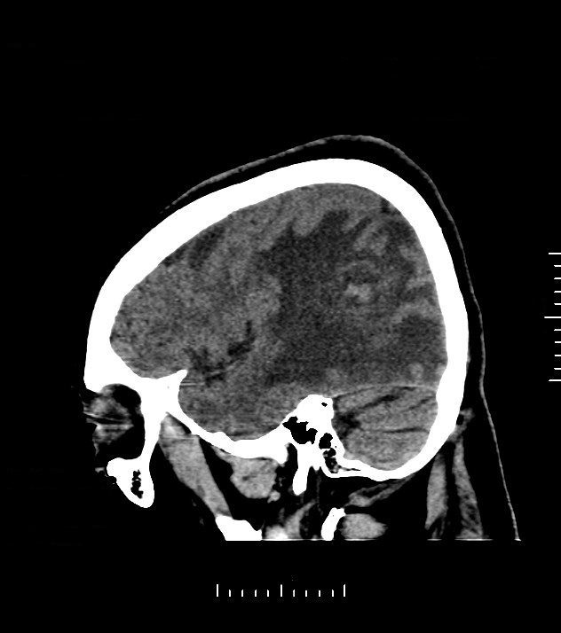 Cholangiocarcinoma with cerebral metastases (Radiopaedia 83519-98628 C 11).jpg