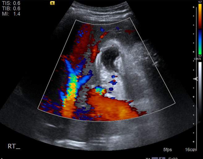File:Cholecystitis - perforated gallbladder (Radiopaedia 57038-63913 A 32).jpg
