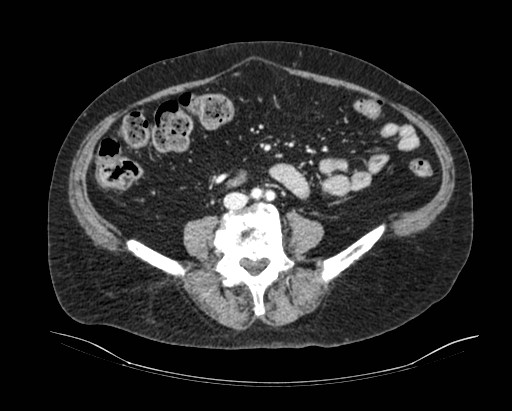 Cholecystoduodenal fistula (Radiopaedia 48959-54022 A 2).jpg