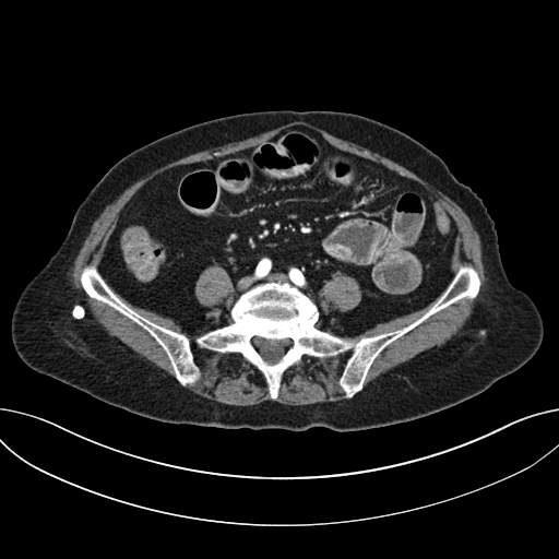 Cholecystoduodenal fistula due to calculous cholecystitis with gallstone migration (Radiopaedia 86875-103077 A 47).jpg