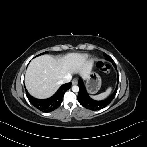 File:Choledocholithiasis after recent cholecystectomy (Radiopaedia 60929-68737 Axial 57).jpg