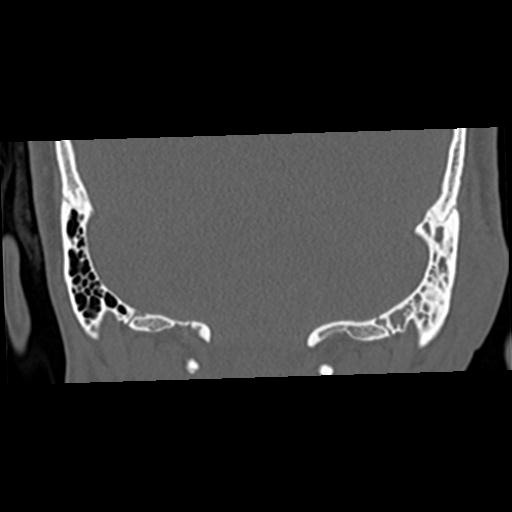 Cholesteatoma (Radiopaedia 84960-100474 Coronal bone window 55).jpg