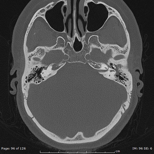 Cholesteatoma - external auditory canal (Radiopaedia 88452-105096 Axial bone window 59).jpg