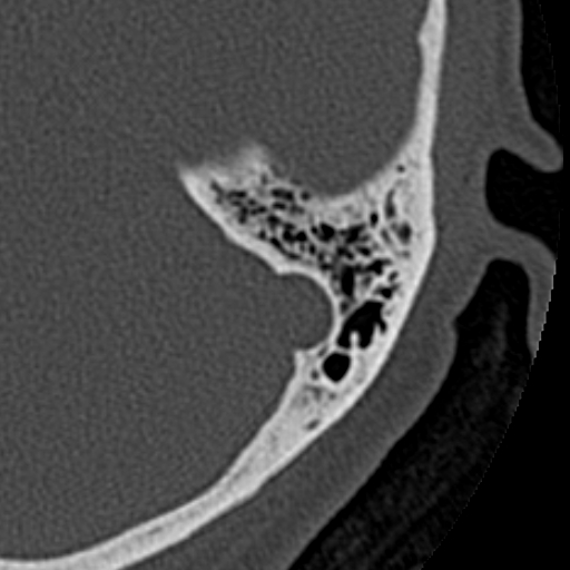 File:Cholesteatoma of the external ear (Radiopaedia 16540-16225 Axial bone window 9).jpg
