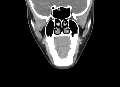 Chondroblastic osteosarcoma (Radiopaedia 67363-76741 D 38).jpg