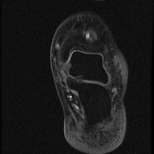 File:Chondroblastoma - midfoot (Radiopaedia 64831-73765 F 1).jpg