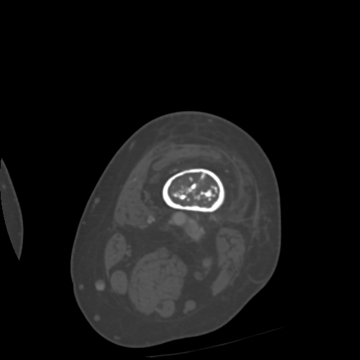 Chondrosarcoma - femur (Radiopaedia 64187-72954 Axial bone window 12).jpg