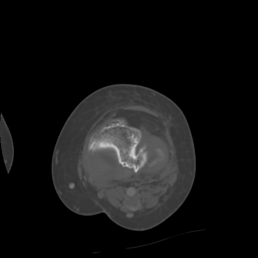 Chondrosarcoma - femur (Radiopaedia 64187-72954 Axial bone window 52).jpg