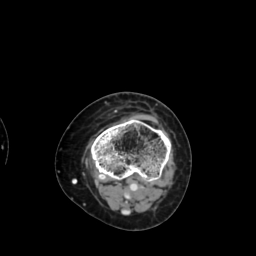 Chondrosarcoma - femur (Radiopaedia 64187-72954 Axial with contrast 66).jpg