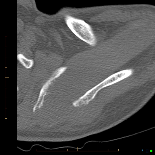 File:Chondrosarcoma of the scapula (Radiopaedia 30696-31399 Axial non-contrast 13).jpg