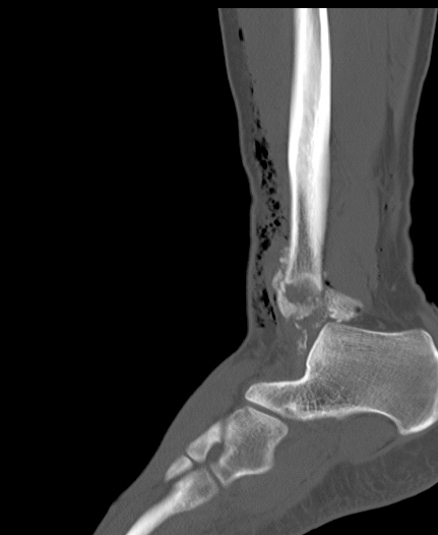 Chopart fracture (Radiopaedia 35347-36851 Sagittal bone window 45).jpg